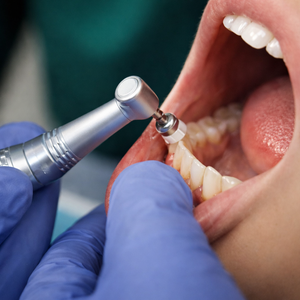Limpieza Dental + Pulido Coronal + Aplicación de Flúor por solo $15 en We Care Smile Studio