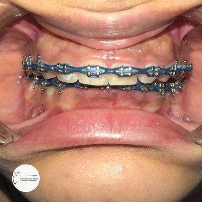 Plan de ortodoncia + Evaluación + Montaje de Brackets +Limpieza Dental + Radiografía Panorámica por $50 en Clínica Dental Metro