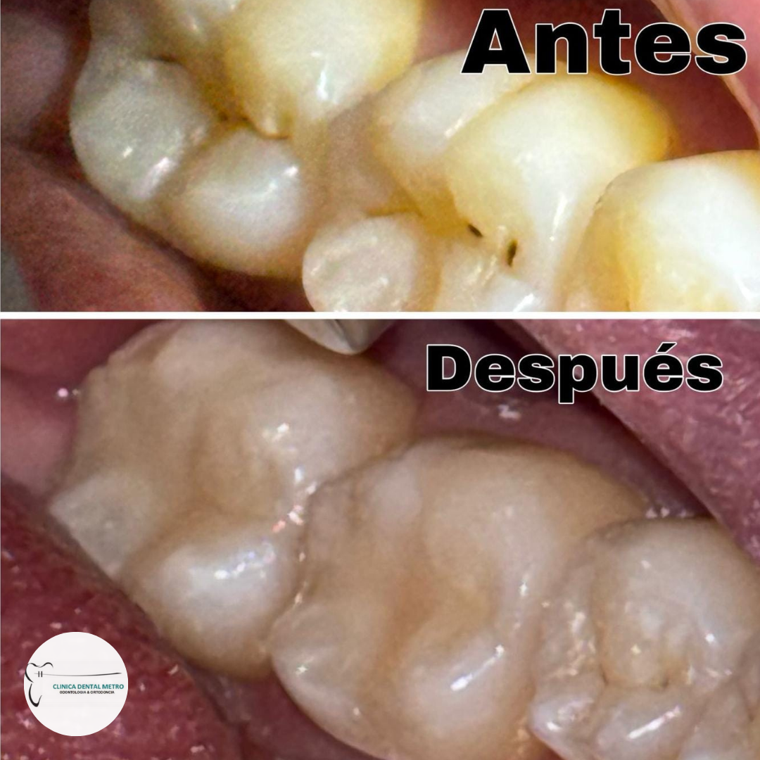 Remoción de Caries en dientes posteriores + Resina + Radiografía por solo $40 en Clínica Dental Metro