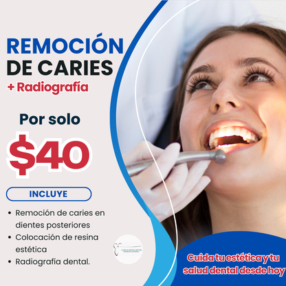 Remoción de Caries en dientes posteriores + Resina + Radiografía por solo $40 en Clínica Dental Metro